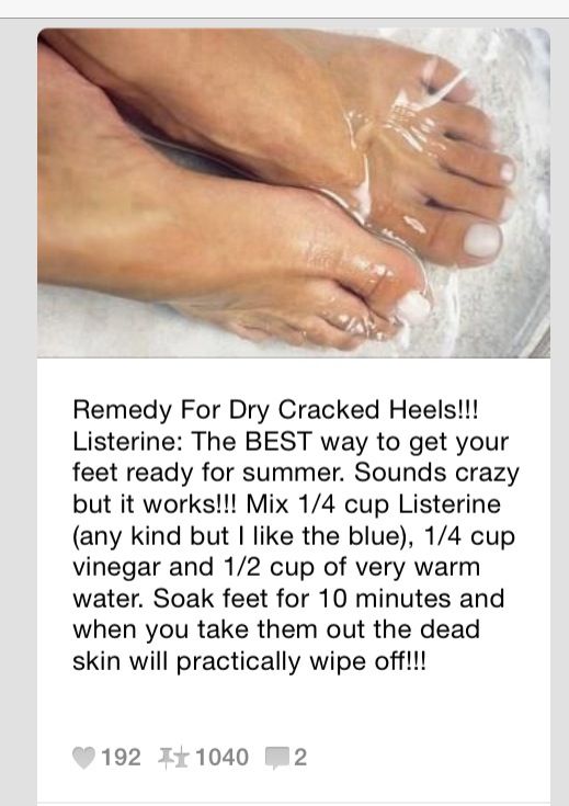 Home remedies for cracked heels in malayalam